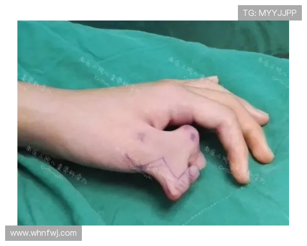 诺伊尔因手指关节囊受伤佩戴特制四指手套积极恢复状态